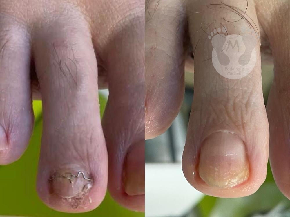 Nagelspangen bei eingewachsenen Fußnägeln in der Praxis für Podologie Michell in Leipzig
